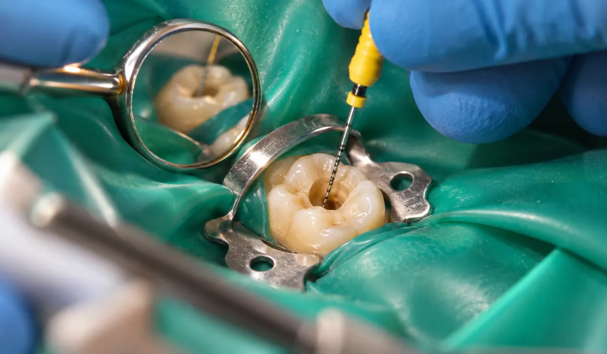 Tratamiento de conductos de un molar con dique de goma y lima de endodoncia.